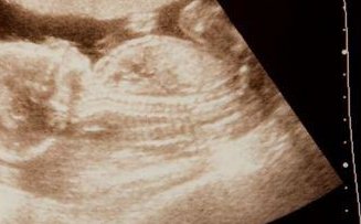 泰国做试管婴儿一共费用多少钱？20万要不要？